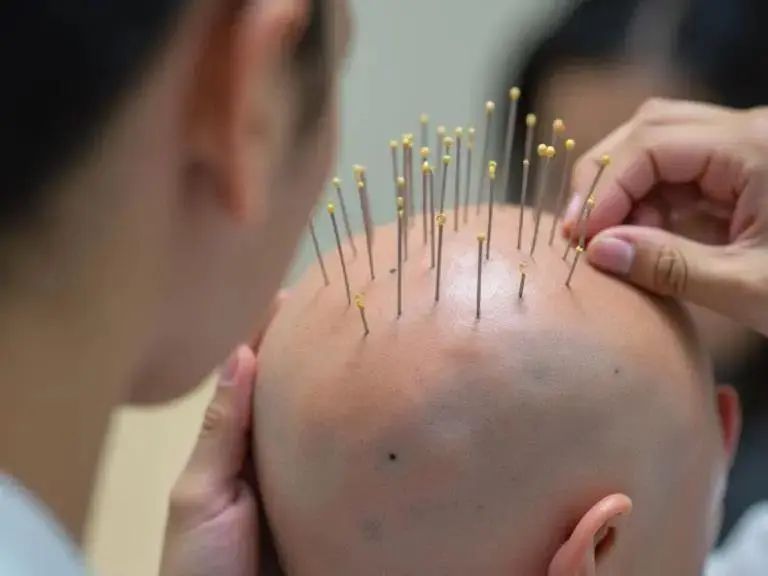 Unveiling Acupuncture Treatment: Is Five Sessions Considered a Course?