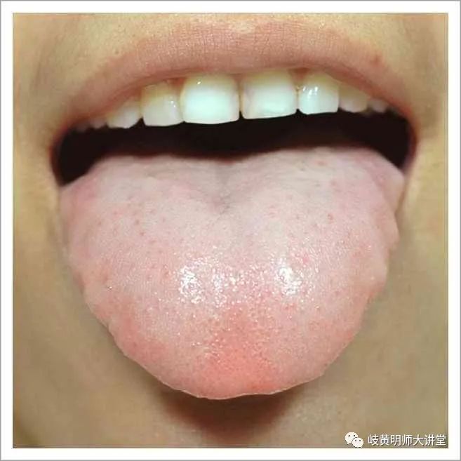 Traditional Chinese Medicine Tongue Diagnosis: Illustrated Guide to 14 Types of Tongue Shapes and Qualities