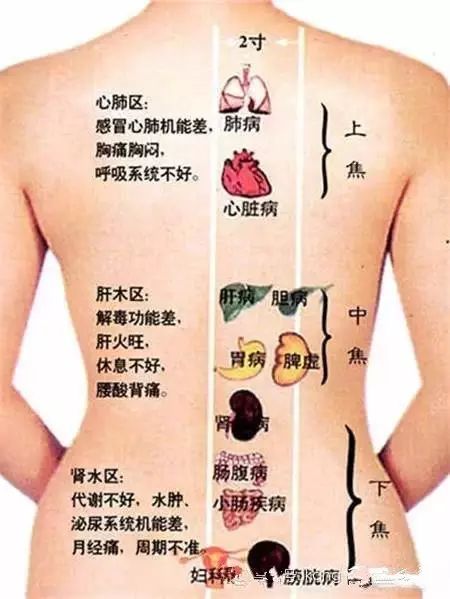 Cupping Therapy on the Back: More Effective than Medication!