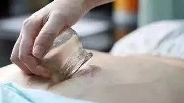Cupping Therapy for the Back: Methods of Retention, Flash, and Sliding Cupping