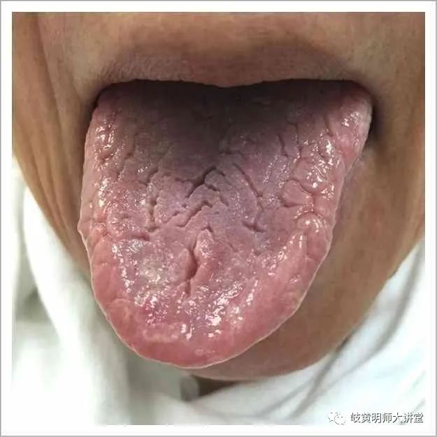 Traditional Chinese Medicine Tongue Diagnosis: Illustrated Guide to 14 Types of Tongue Shapes and Qualities