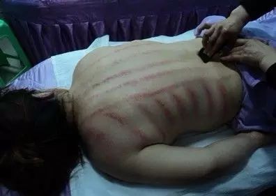 Gua Sha, Massage, and Bloodletting: A Cautionary Tale from Nanning