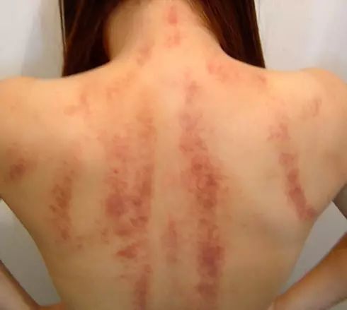 The Eight Most Common Techniques of Gua Sha and Comprehensive Analysis of Sha Patterns