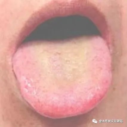 Tongue Diagnosis in Traditional Chinese Medicine: Tongue Coating