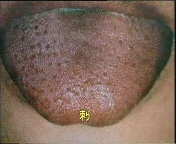 The Health Code Hidden on Your Tongue