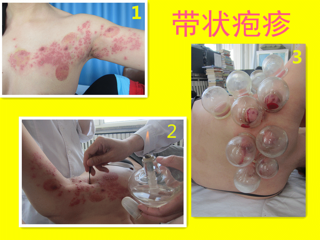 Shingles Pain: The Remarkable Efficacy of Fire Needle Therapy
