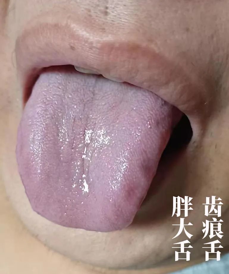 The Body Signals Illness: Understanding Tongue Diagnosis in TCM
