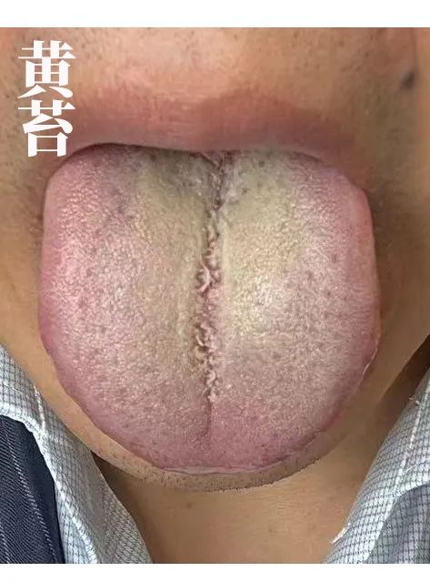 The Body Signals Illness: Understanding Tongue Diagnosis in TCM