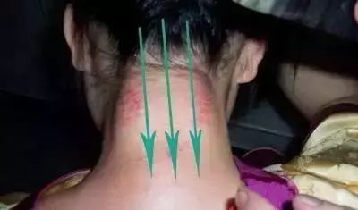 Specific Gua Sha Techniques for the Whole Body: Please Remember!