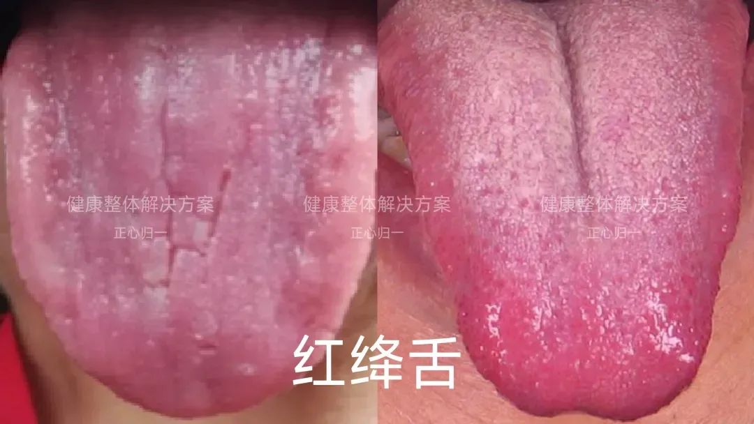 Observing the Tongue for Health: How to Analyze Tongue Quality?