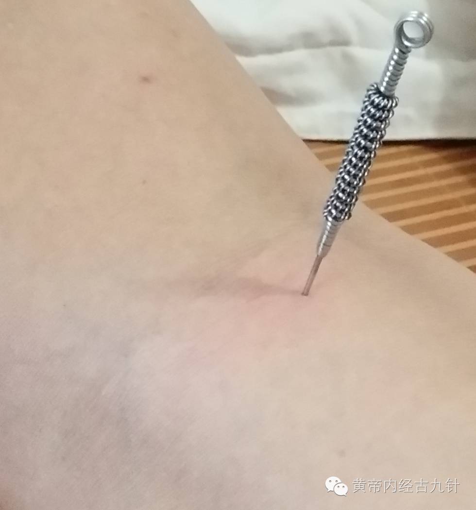 Discussion on the 'Mao Zhen' (Fine Needle) Technique