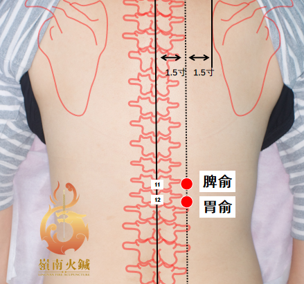 Lingnan Fire Needle Therapy for Post-New Year Food Accumulation
