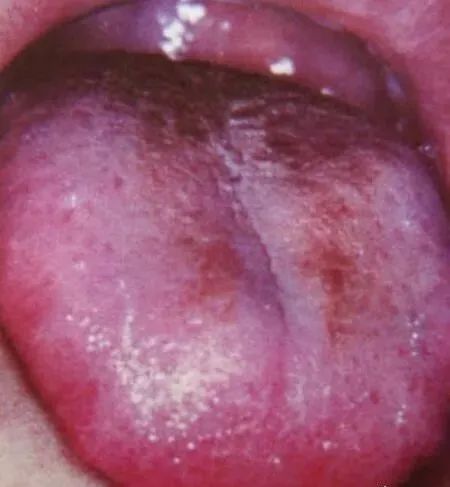 Comprehensive Guide to Tongue Diagnosis and Associated Conditions in TCM