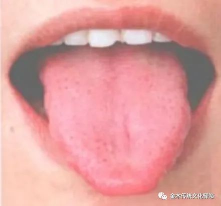 Tongue Diagnosis in Traditional Chinese Medicine: Tongue Coating
