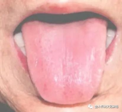 Tongue Diagnosis in Traditional Chinese Medicine: Characteristics of Tongue Coating