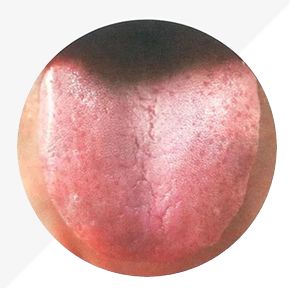 Understanding Tongue Diagnosis in TCM: Insights into Health from Tongue Appearance (Part 2)
