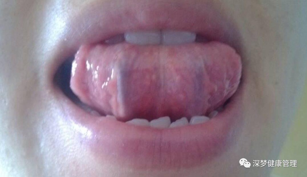 How to Regulate Blood Stasis Constitution to Prevent Illness?