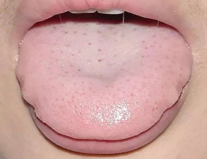 Tongue Diagnosis - Illustrated Guide to Tongue Manifestations