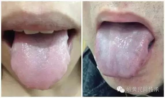 Understanding Your Body Constitution Through Tongue Coating Observation