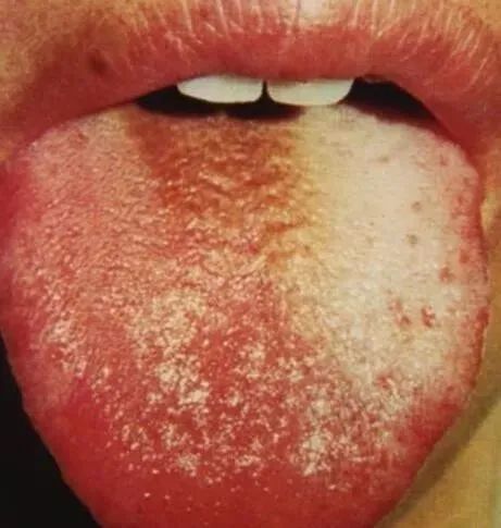 Comprehensive Guide to Tongue Diagnosis and Associated Conditions in TCM