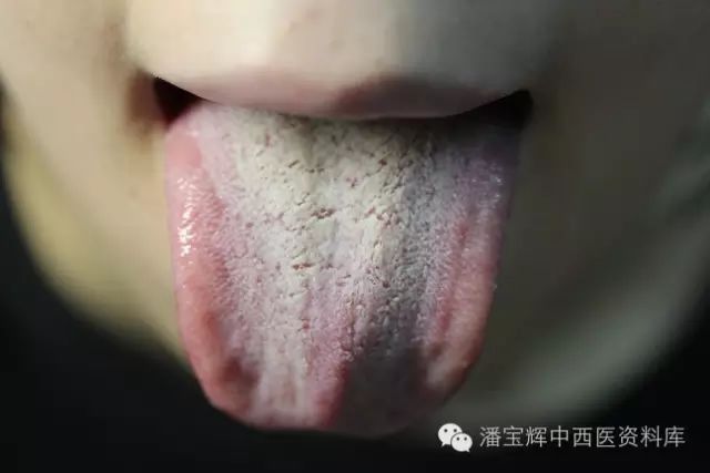Foundations of Traditional Chinese Medicine: Phlegm-Dampness