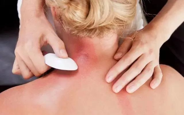 Chen Xuedong Shares His Gua Sha Experience: Experts Warn Against Incorrect Techniques That May Harm Kidney Function!