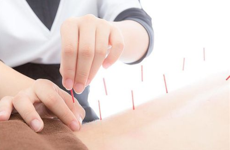 The Nine Brothers of Acupuncture: The Fine Needle is Just One of Them