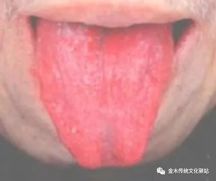Tongue Diagnosis in Traditional Chinese Medicine: Characteristics of Tongue Coating