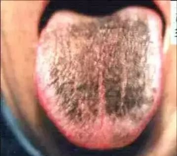The Most Comprehensive Guide to Tongue Diagnosis! Master It and Become a Tongue Diagnosis Expert