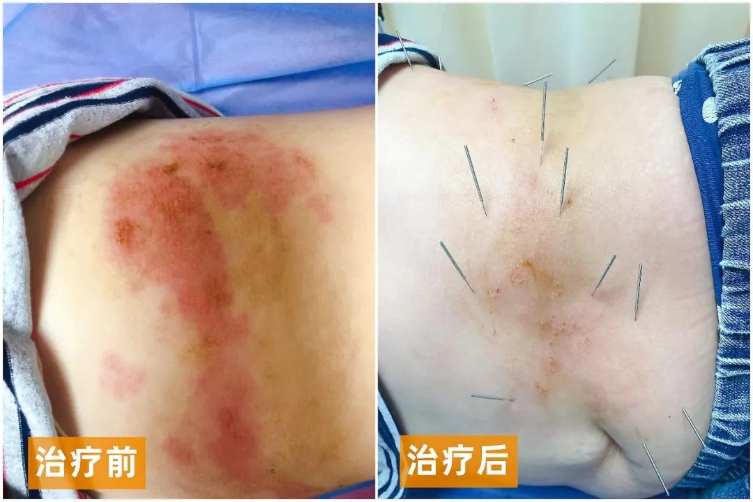 Acupuncture Techniques to Alleviate Shingles Pain