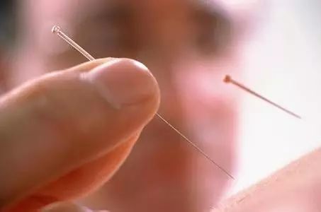 Acupuncture Techniques (A Must-Read for Acupuncturists)