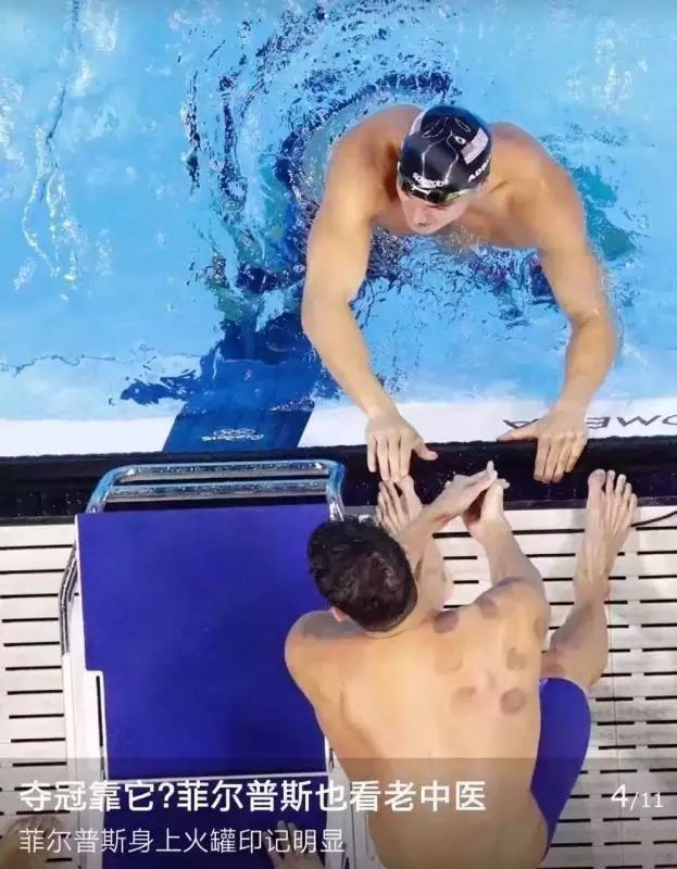 Cupping Therapy Shines at the Rio Olympics