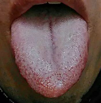 Precious Tongue Diagnosis: Identifying Stomach Yin Deficiency, Severe Yin Fluid Deficiency, Liver Blood Deficiency, and Yang Deficiency with Insufficient Qi and Blood