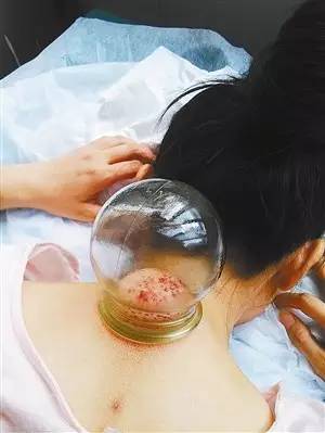 The Benefits of Bloodletting Therapy in Traditional Chinese Medicine
