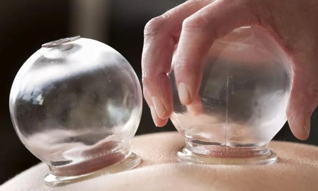 Cupping Therapy: A Traditional Chinese Medicine Approach to Health