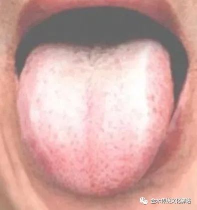 Tongue Diagnosis in Traditional Chinese Medicine: Characteristics of Tongue Coating