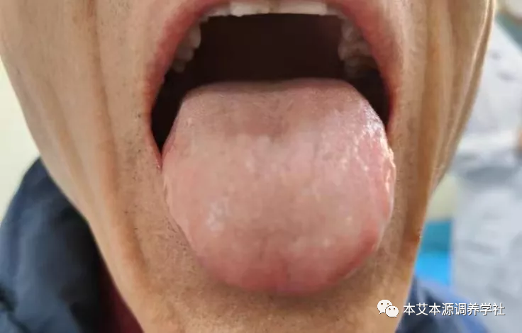 Tongue Diagnosis Series 3: Precise Differentiation of Tongue Coating, Quality, and Shape