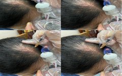 Essential Knowledge of Fire Needle Therapy in Dermatology