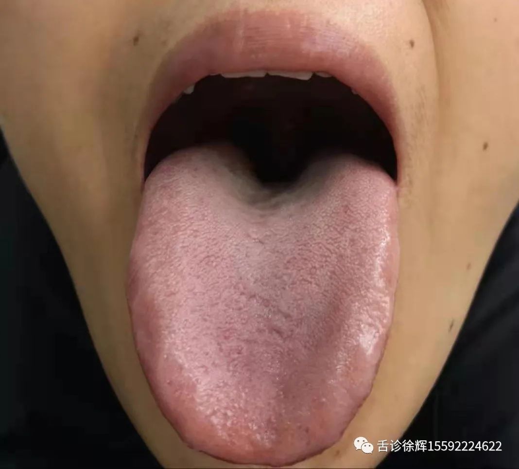 Analysis of Tongue Appearance: Discussing the Reasons for Variations in Tongue Shape and Color at Different Times