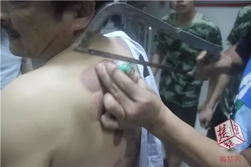 Man Gets Stuck in Cupping Therapy! Firefighters Called for Rescue... Would You Dare to Try It?