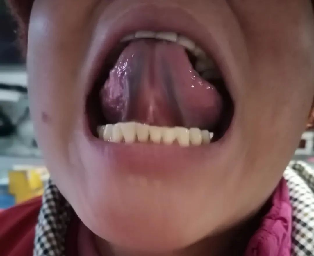 A Case of Unexpected Recovery from Urinary Incontinence Following a Common Cold