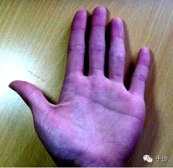 Eight Principles of Hand Diagnosis Based on Color Observation (Must-Collect)