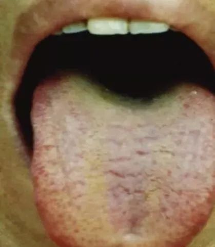 Comprehensive Guide to Tongue Diagnosis and Associated Conditions in TCM