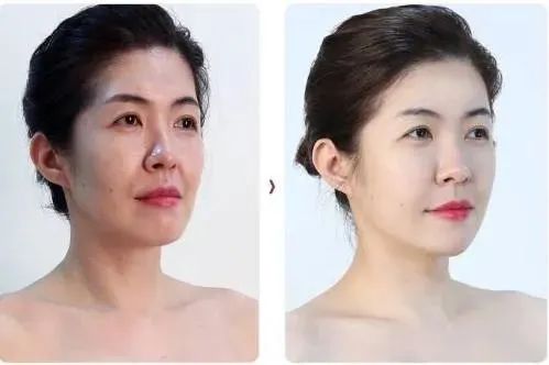 Moxibustion: A Quick Way to Lift Sagging Faces!