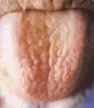 Comprehensive Guide to Tongue Diagnosis: Learn How Your Tongue Reflects Your Health!