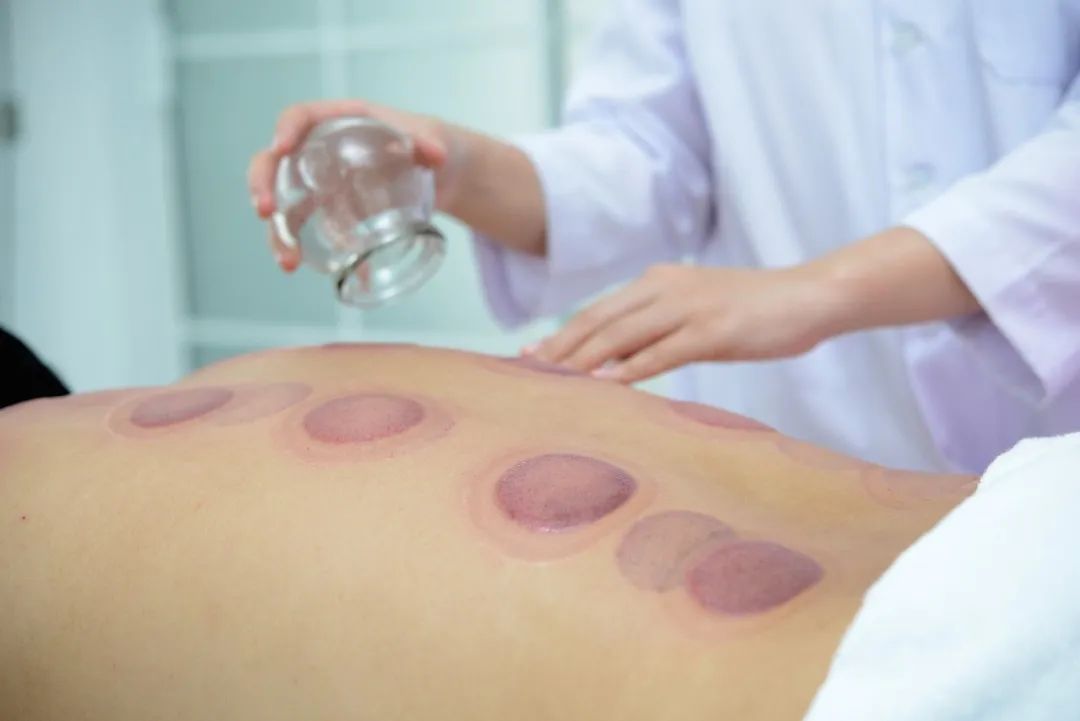 Cupping Therapy: Not Everyone Should Try It! 7 Situations to Avoid