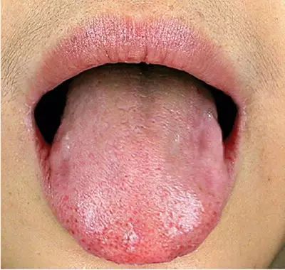Blood Stasis and Its Impact on Health: How to Care for Individuals with Blood Stasis Constitution
