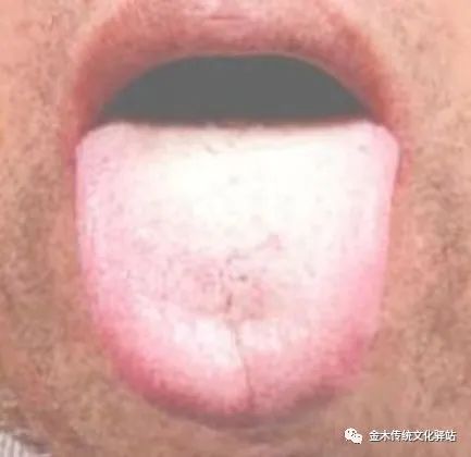 Tongue Diagnosis in Traditional Chinese Medicine: Tongue Coating
