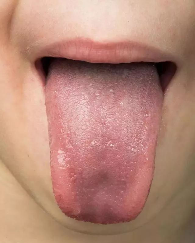 Tongue Diagnosis in Traditional Chinese Medicine: Observing Tongue Color, Shape, State, and Coating