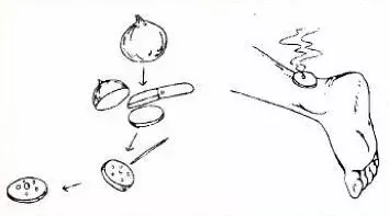 The Most Comprehensive Explanation of Moxibustion Methods and Techniques (A Must-Read for Beginners)
